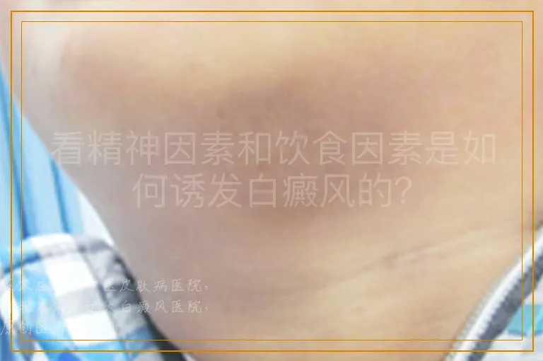 看精神因素和饮食因素是如何诱发白癜风的？