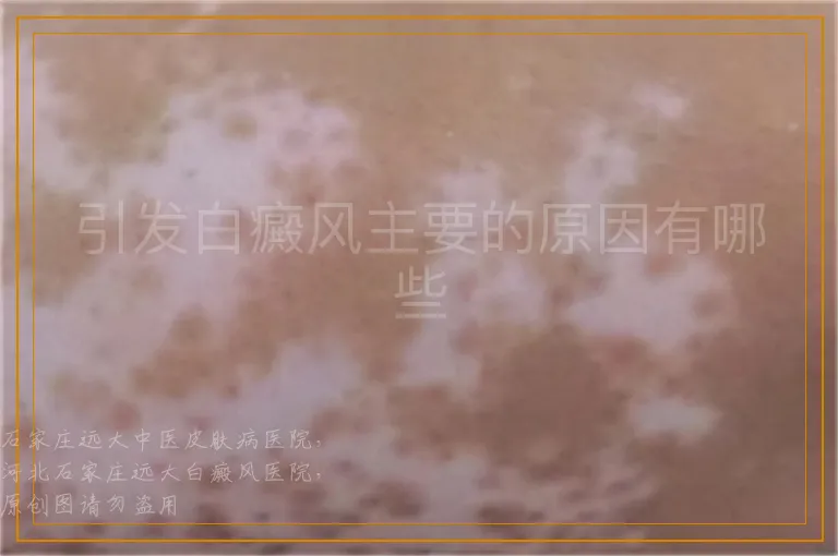 引发白癜风主要的原因有哪些