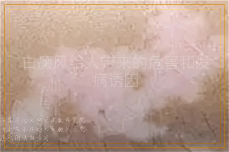 白癜风给人带来的危害和发病诱因