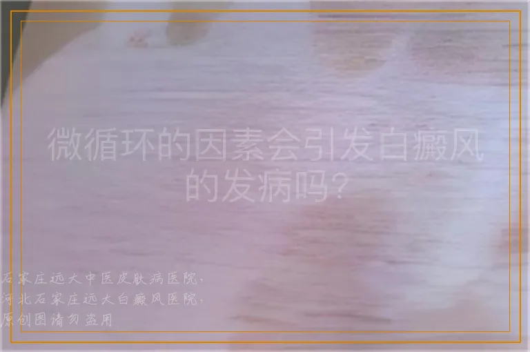微循环的因素会引发白癜风的发病吗?
