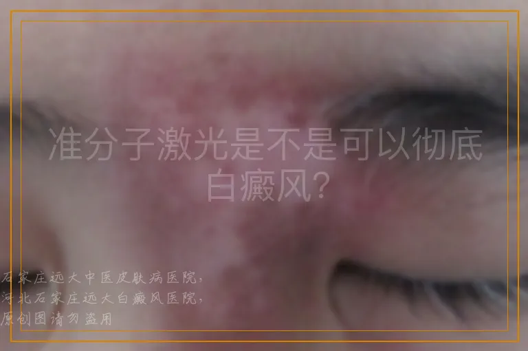 准分子激光是不是可以彻底白癜风？