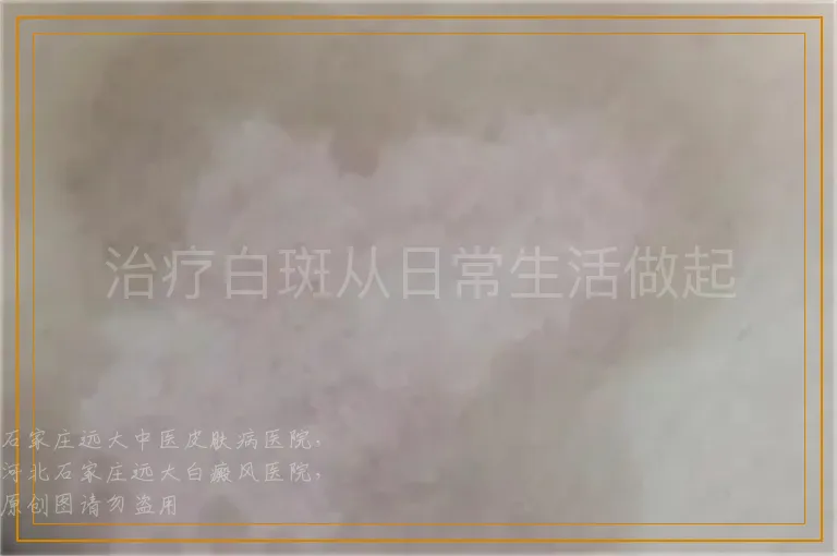 治疗白斑从日常生活做起