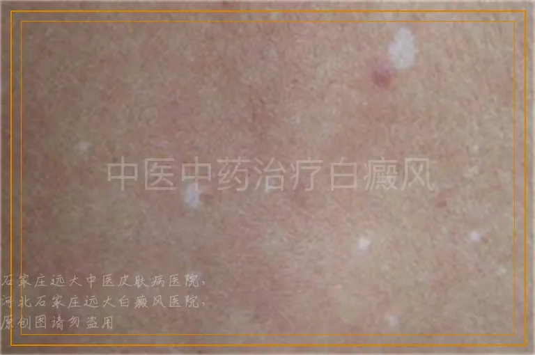 中医中药治疗白癜风