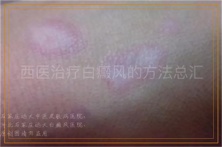 西医治疗白癜风的方法总汇