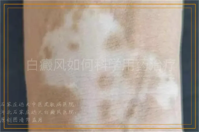 白癜风如何科学用药治疗