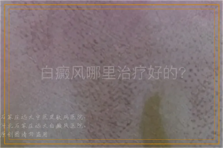 白癜风哪里治疗好的?