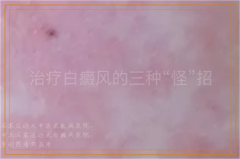 治疗白癜风的三种“怪”招