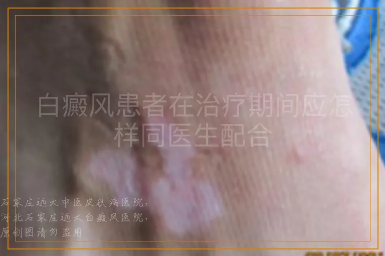 白癜风患者在治疗期间应怎样同医生配合