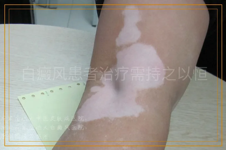 白癜风患者治疗需持之以恒