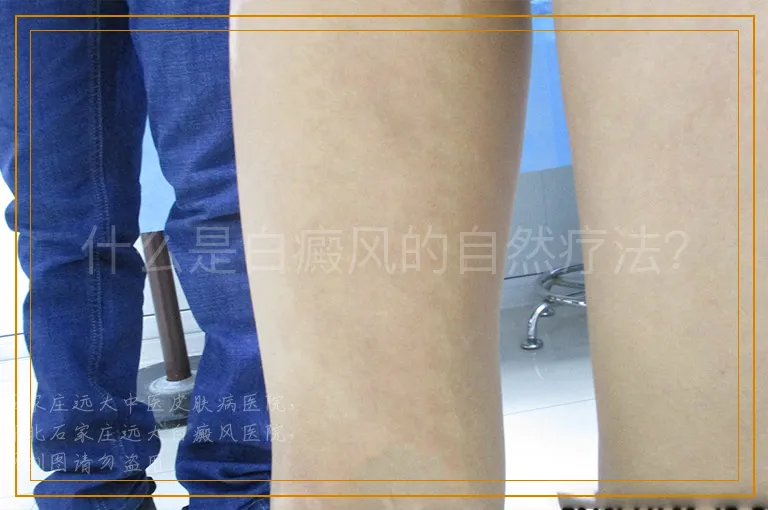 什么是白癜风的自然疗法？