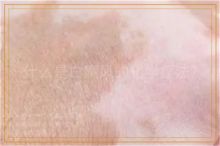 什么是白癜风的化学疗法？