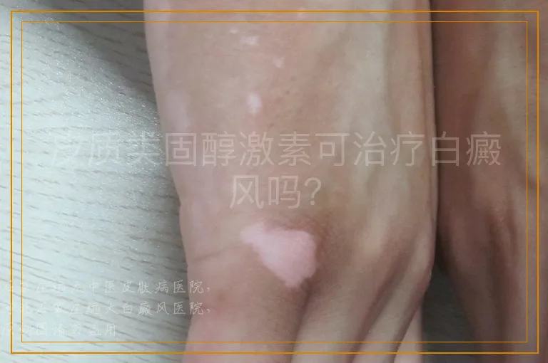 皮质类固醇激素可治疗白癜风吗？