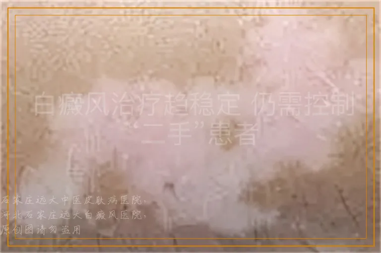 白癜风治疗趋稳定 仍需控制“二手”患者
