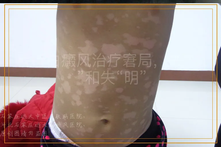 看待白癜风治疗窘局，失“衡”和失“明”
