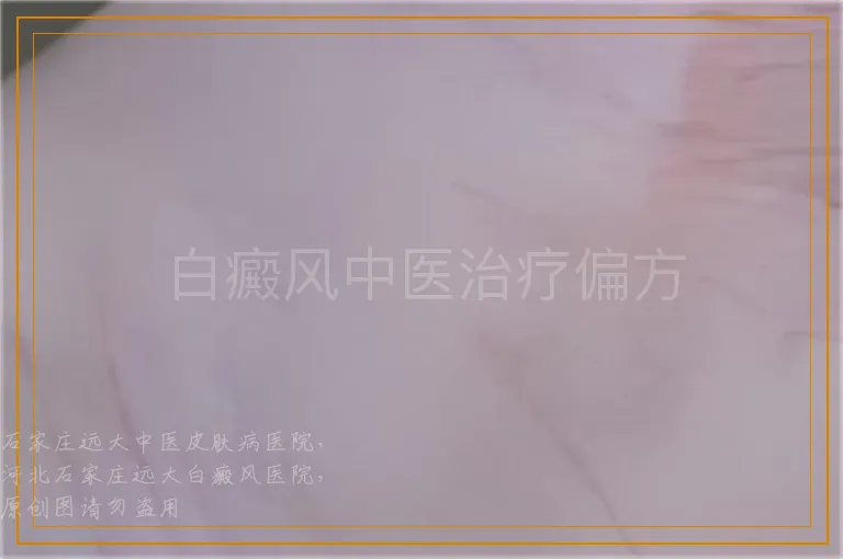 白癜风中医治疗偏方