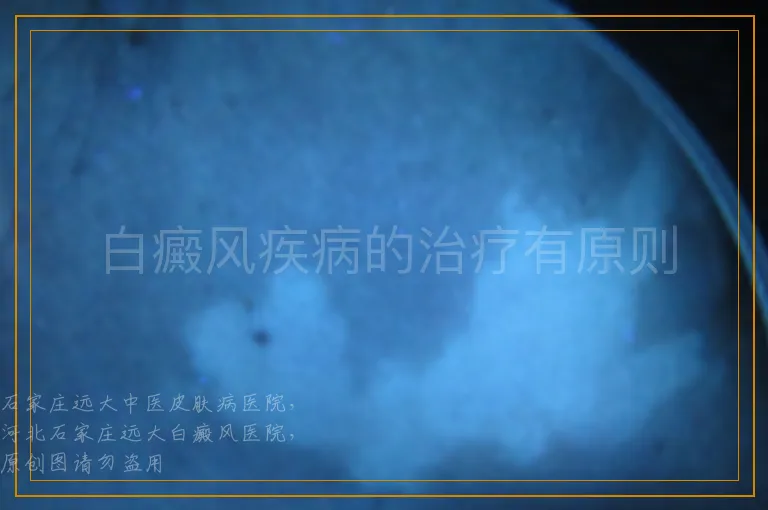白癜风疾病的治疗有原则