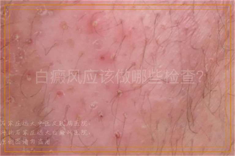 白癜风应该做哪些检查？