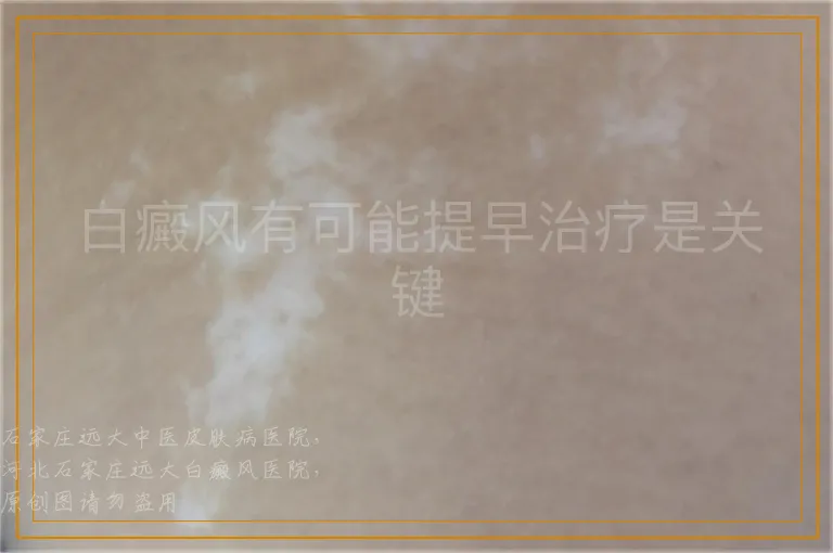 白癜风有可能提早治疗是关键
