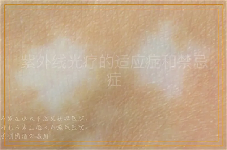 紫外线光疗的适应症和禁忌症