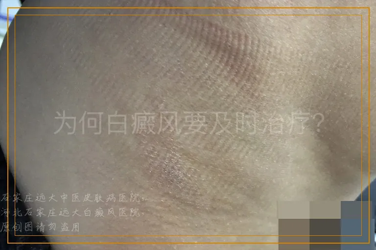 为何白癜风要及时治疗？