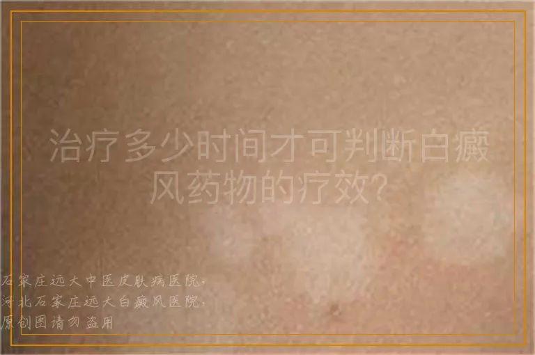 治疗多少时间才可判断白癜风药物的疗效？