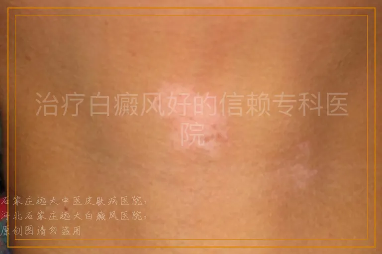 治疗白癜风好的信赖专科医院