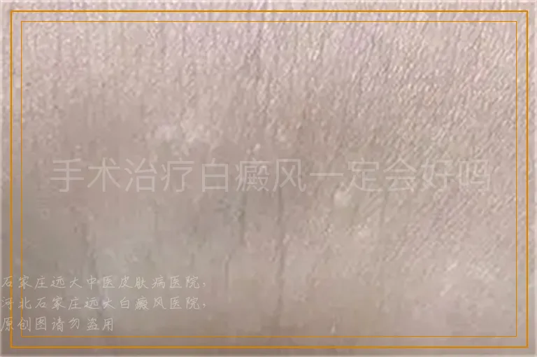 手术治疗白癜风一定会好吗