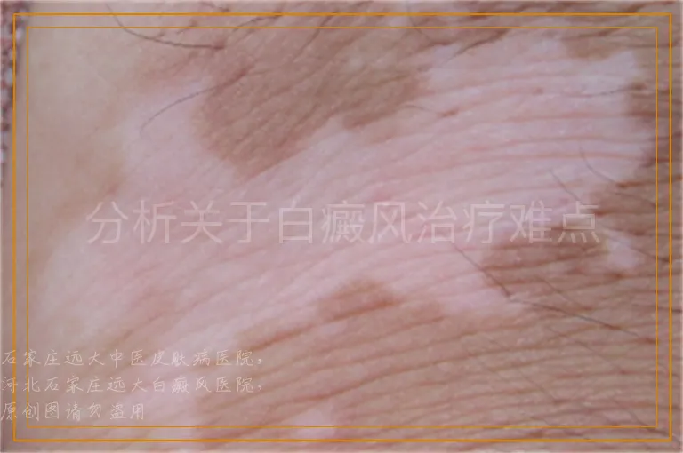 分析关于白癜风治疗难点