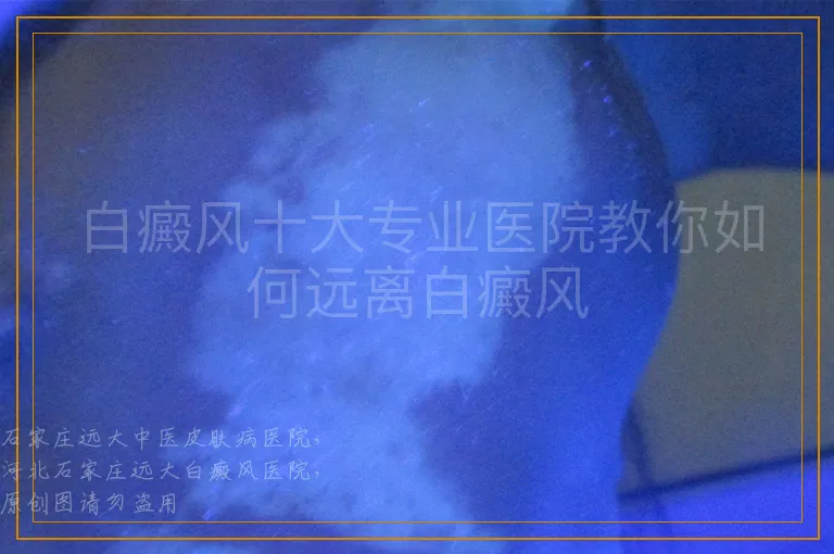 白癜风十大专业医院教你如何远离白癜风
