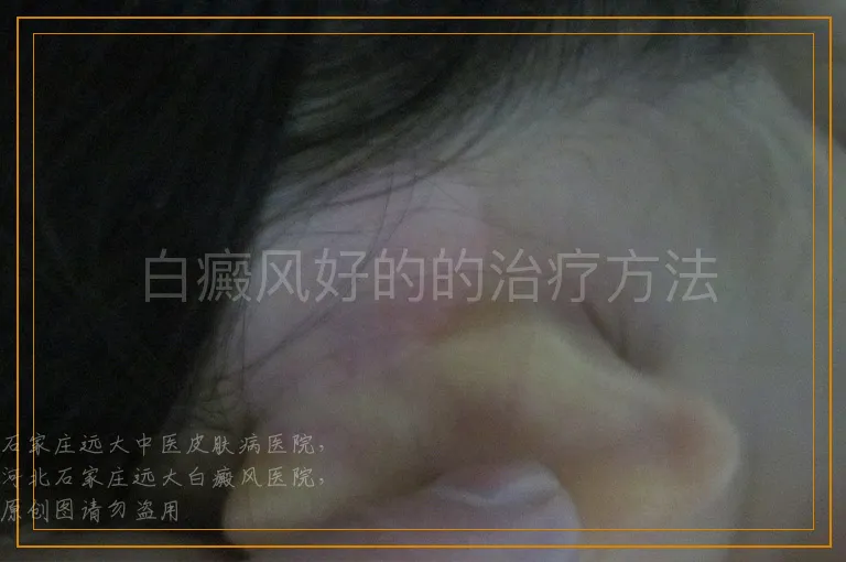 白癜风好的的治疗方法