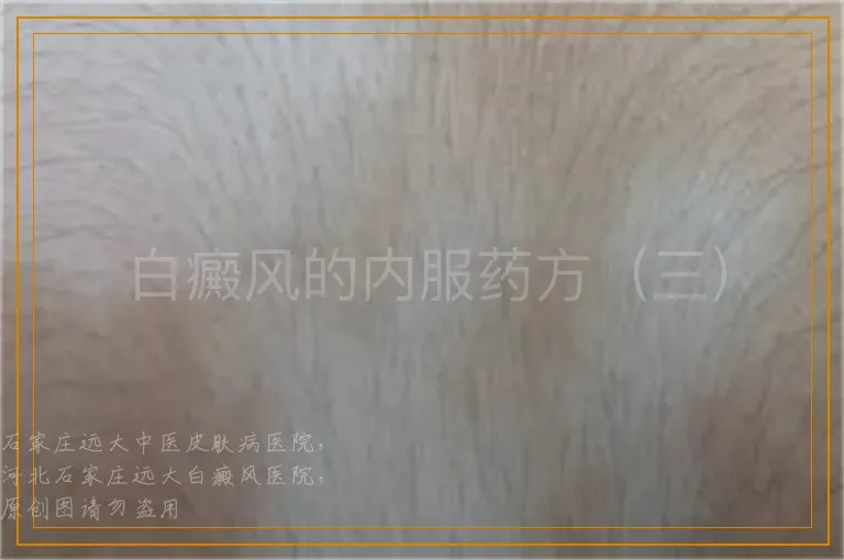 白癜风的内服药方（三）