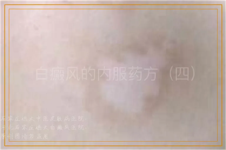 白癜风的内服药方（四）