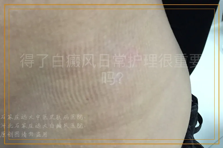 得了白癜风日常护理很重要吗？
