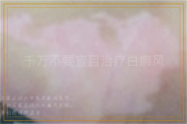 千万不要盲目治疗白癜风