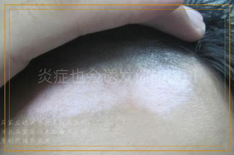 炎症也会诱发你的白斑