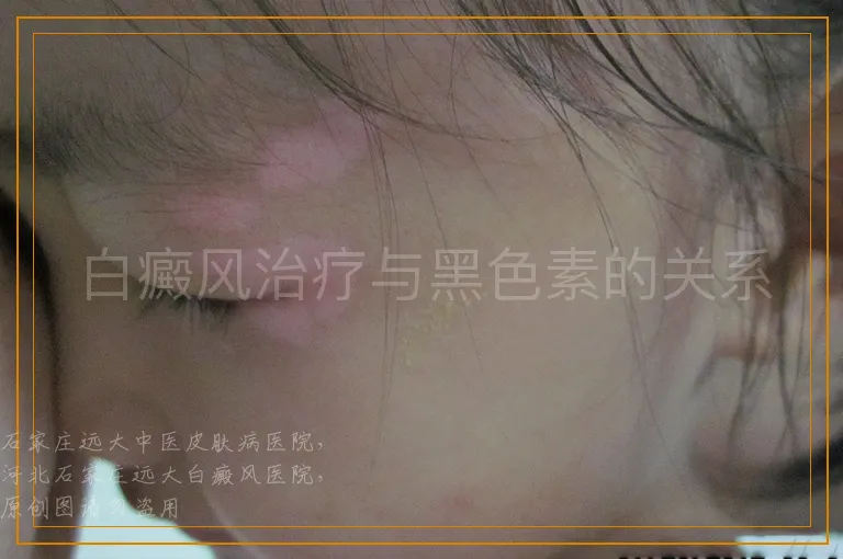 白癜风治疗与黑色素的关系