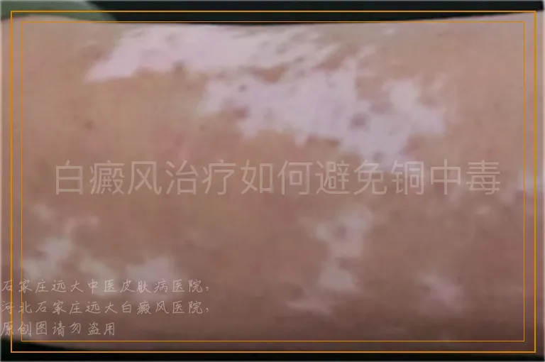 白癜风治疗如何避免铜中毒