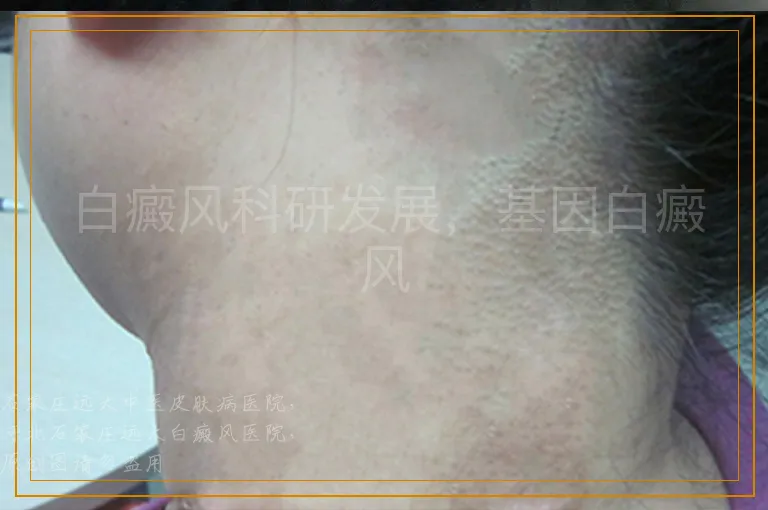 白癜风科研发展，基因白癜风