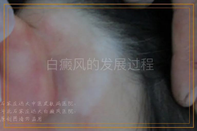 白癜风的发展过程
