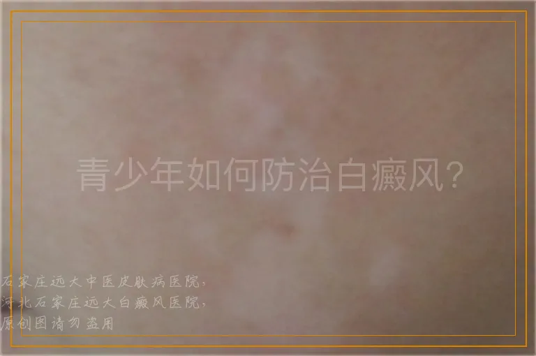 青少年如何防治白癜风?