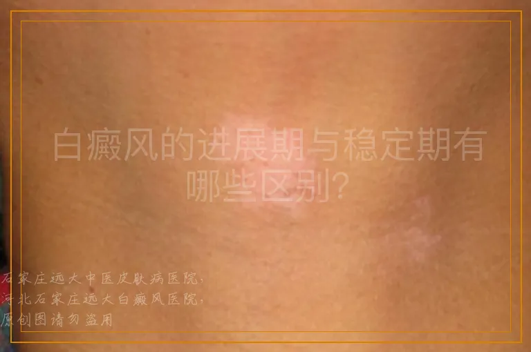 白癜风的进展期与稳定期有哪些区别？