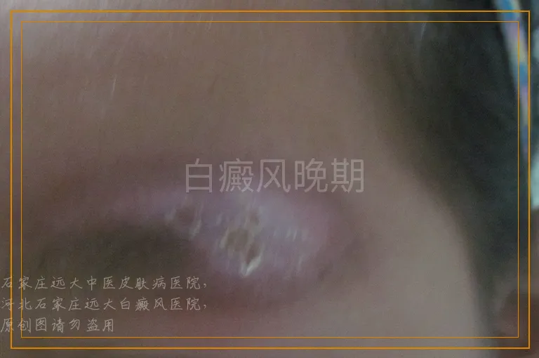 白癜风晚期