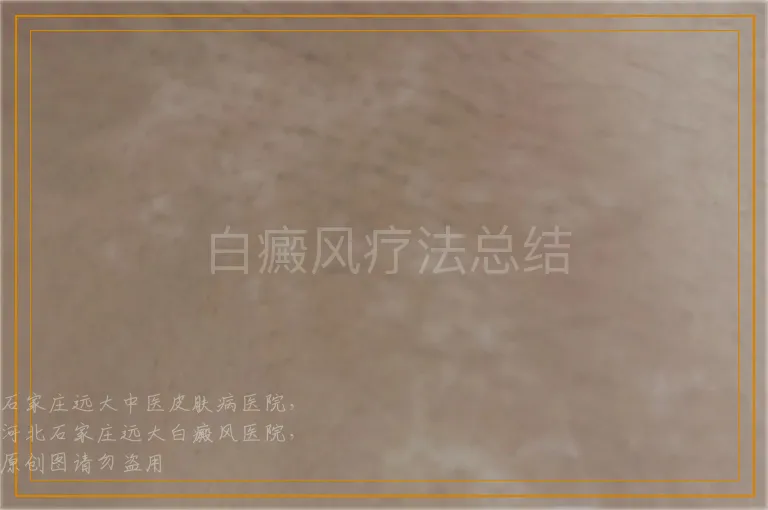 白癜风疗法总结