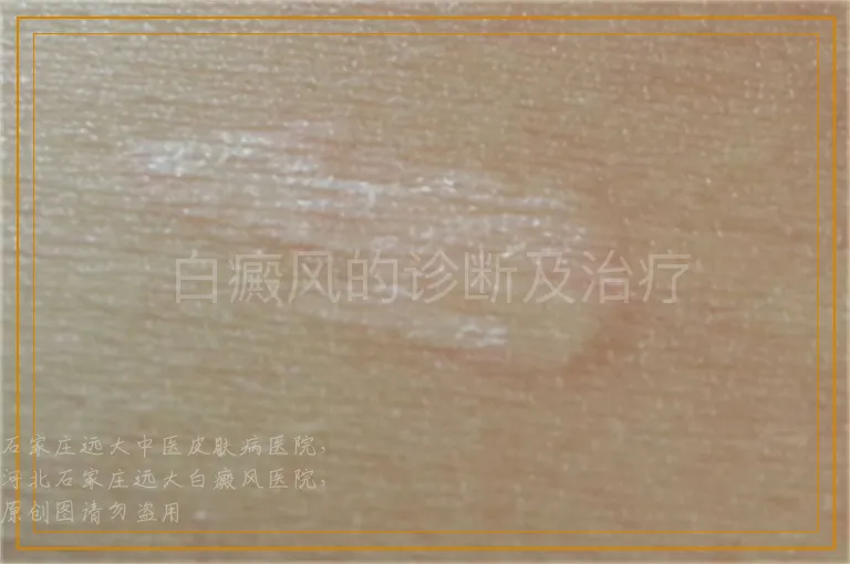 白癜风的诊断及治疗