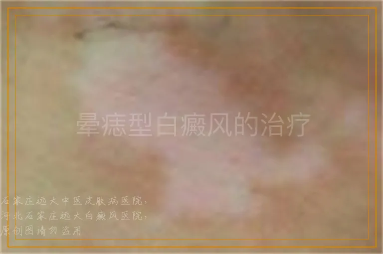 晕痣型白癜风的治疗
