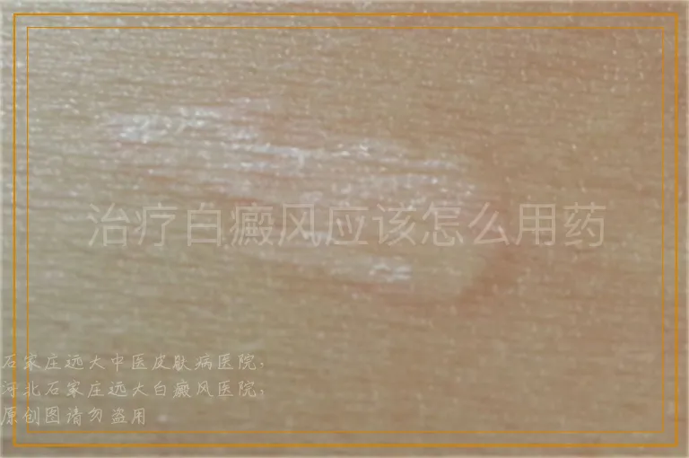 治疗白癜风应该怎么用药