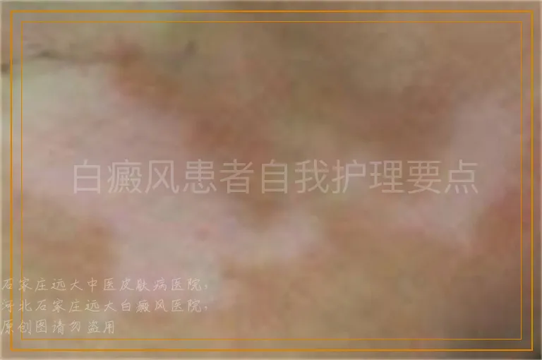 白癜风患者自我护理要点