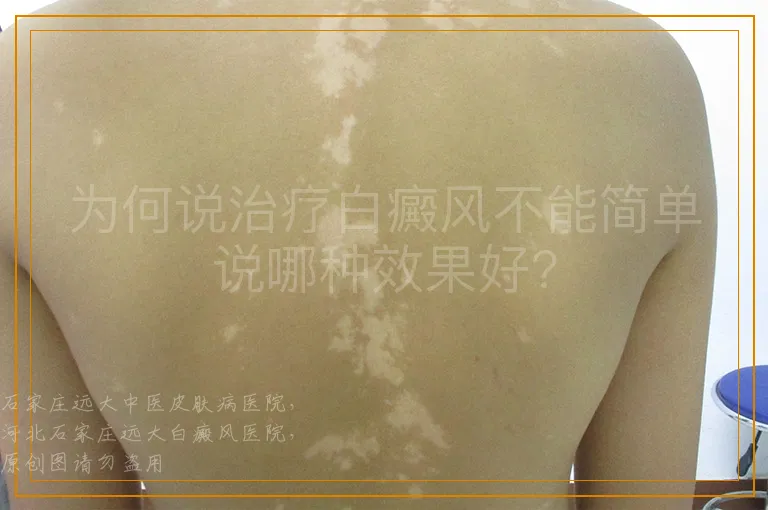 为何说治疗白癜风不能简单说哪种效果好?