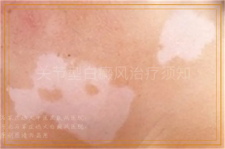 关节型白癜风治疗须知