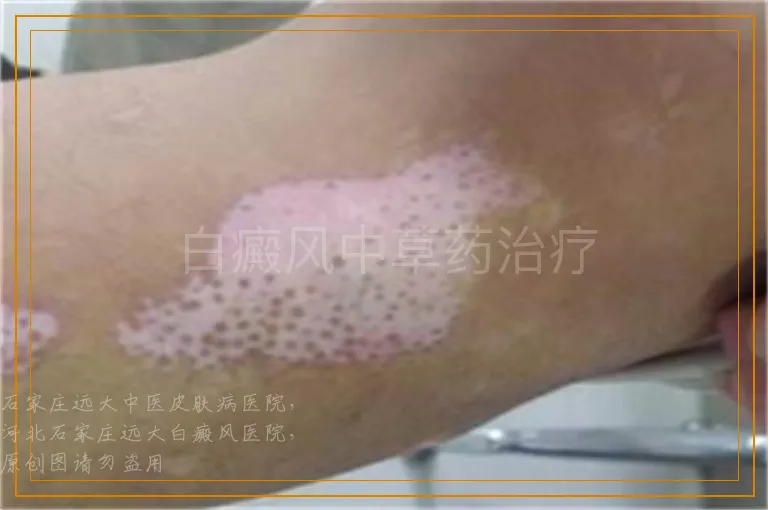 白癜风中草药治疗